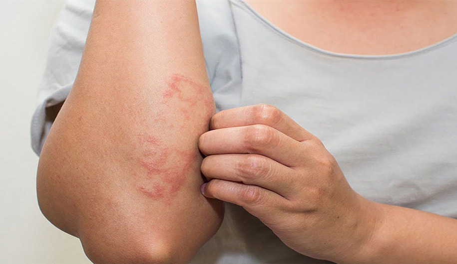 Dr.Abidi-hives|نسخۀ کهیر را در چند دقیقه بپیچید