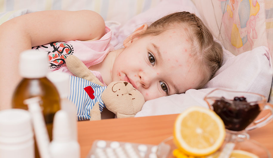 chicken pox | آبله مرغان