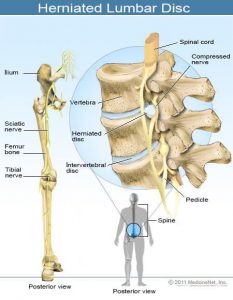 herniated-lumbar-disc